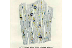 Опыт советской медицины в Великой Отечественной войне. М. 1951. Т 28. Нарушения общего питания. С.72—73