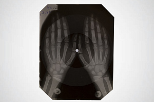 Пластинка на рентгеновском снимке. Подпольная запись, самиздат